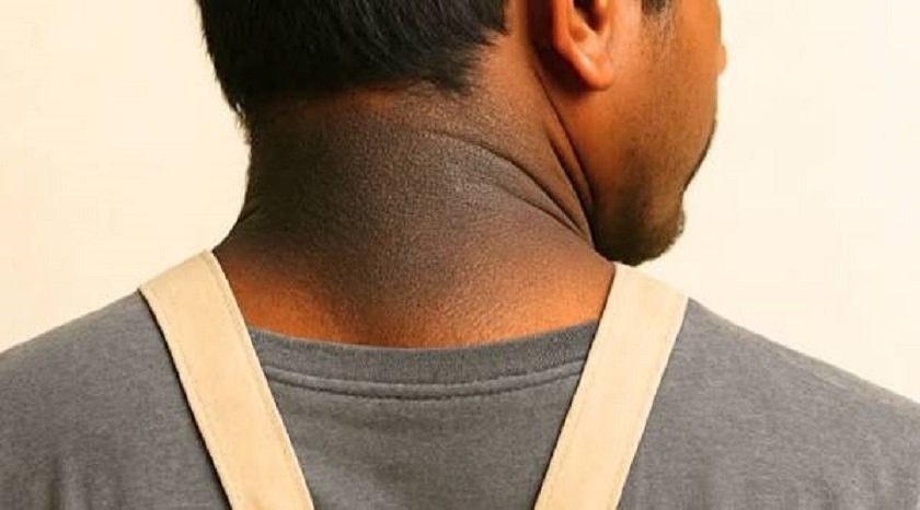 गर्धन कालो हुनुको कारण के हो ?